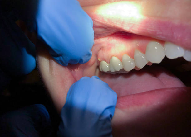 Best Emergency Treatment for Dental Infections or Abscesses in Stanhope, NJ